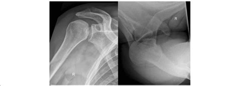 Axial And Ap View Of Posterior Shoulder Dislocation Download