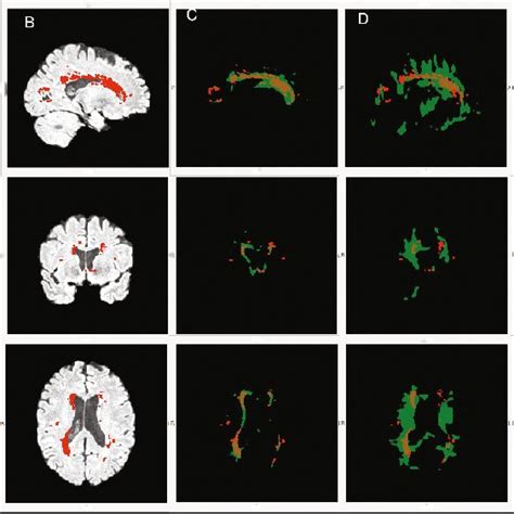 Pdf A 2d3d Convolutional Neural Network For Brain White Matter Lesion Detection In Multimodal Mri