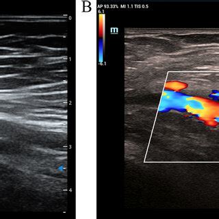 B Ultrasound Of Lower Extremity Veins Before And After Treatment In