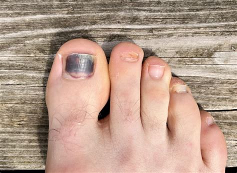 Black Toenail Infection