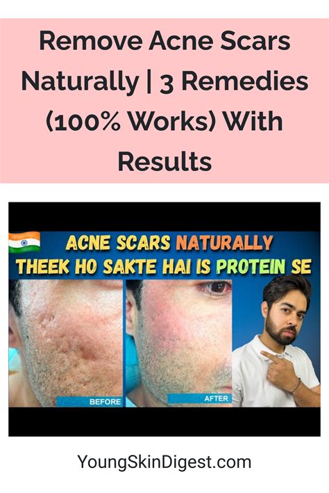 Remove Acne Scars Naturally 3 Remedies 100 Works With Results