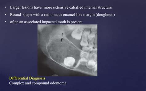 RADIOGRAPHIC FEATURES OF TUMORS OF JAWS PPT