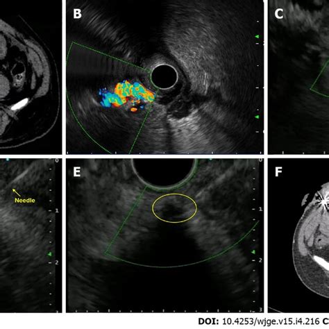 Endoscopic Ultrasound Guided Vascular Therapy For Pseudoaneurysm A