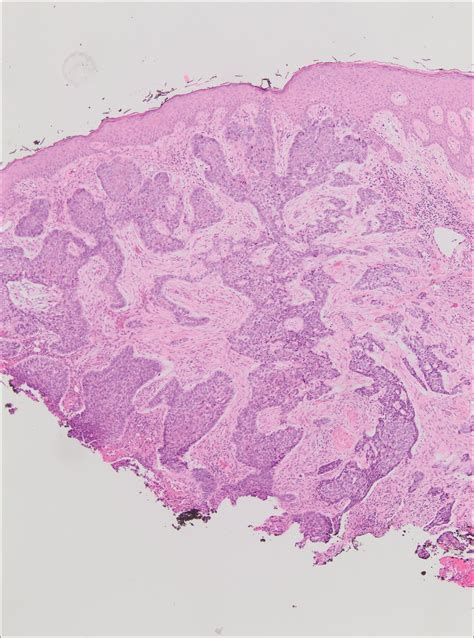 Squamous Cell Carcinoma Vs Basal Cell Carcinoma Histology