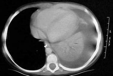 Chylothorax Background Etiopathophysiology Prognosis