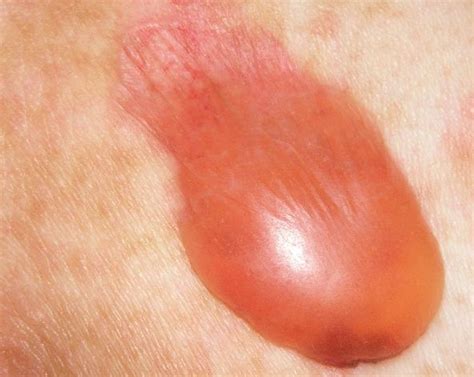 Bullous Pemphigoid Treatment Pictures Photos