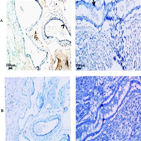 Immunohistochemical Staining Of Sma In A Avm Nidus Structures And