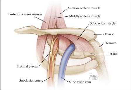 Thoracic Outlet Syndrome: Treatment, Symptoms, Causes & Diagnosis