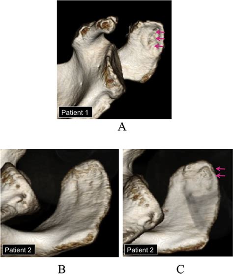 Three Dimensional Computed Tomography A Subacromial Bone Erosion Due