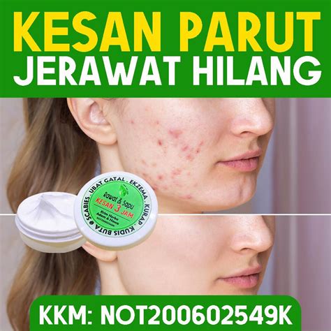 Ubat Parut Jeragat Jerawat Krim Gatal Kudis Ruam Elergik Kulat