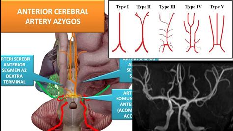 Video 38 Anterior Cerebral Artery Azygos YouTube