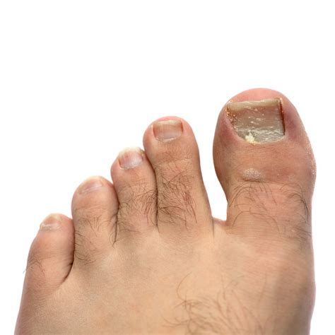 Toenail Falling Off The Secret Podiatrist Tip To Getting It To Grow Back