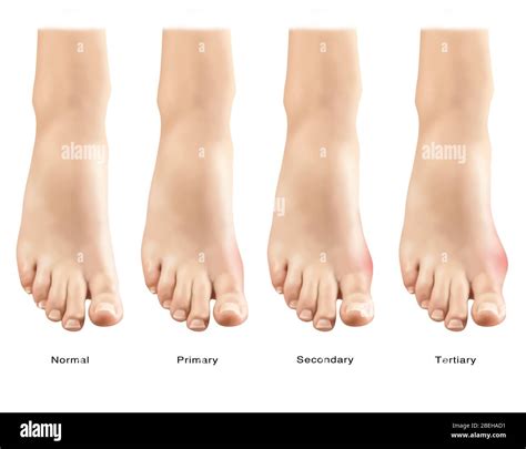 Gout Is A Type Of Inflammatory Arthritis A Red Tender Hot And Swollen Joint The Joint At