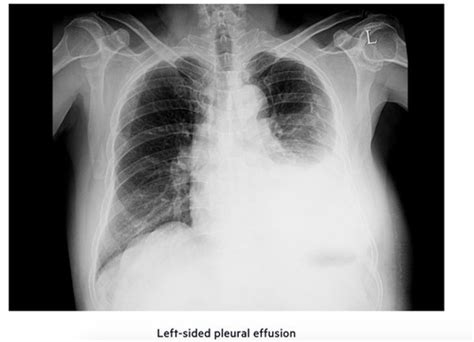 Pleural Effusion Flashcards Quizlet