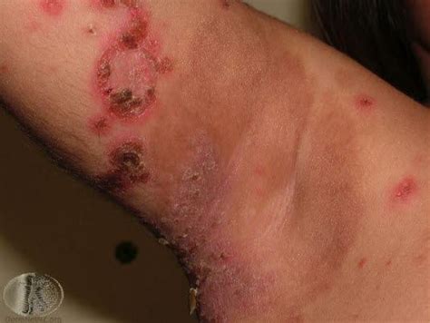 Impetigo Medibas Kunskapsstöd För Hälso Och Sjukvårdspersonal