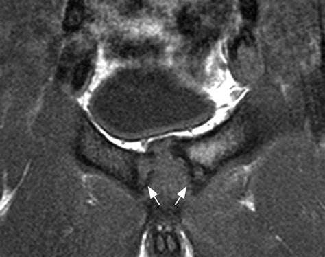 Athletic Pubalgia And Sports Hernia” Optimal Mr Imaging Technique And