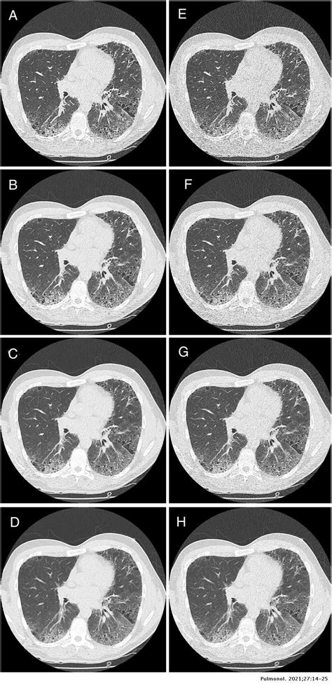 Low Dose Computed Tomography Of The Lung For Detection And Grading Of Interstitial Lung Disease