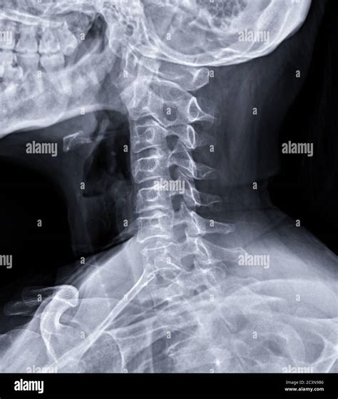 X Ray C Spine Or X Ray Image Of Cervical Spine Oblique View For