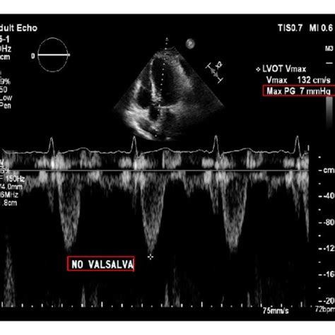 Postoperative Transthoracic Echocardiogram Demonstrating Resting Left