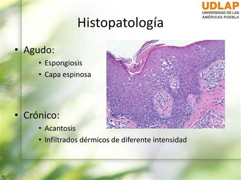 Dermatitis Atópica Y Eccema Numular Sin Videos Ppt