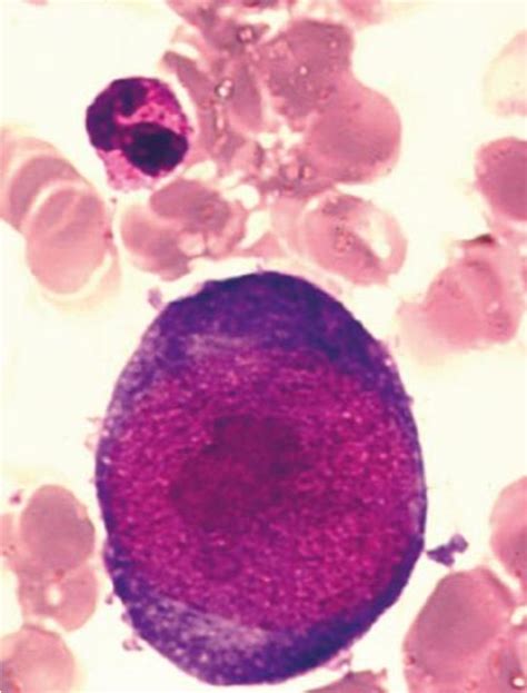 Figure 4 From Infection à Parvovirus B19 Chez Ladulte Variété