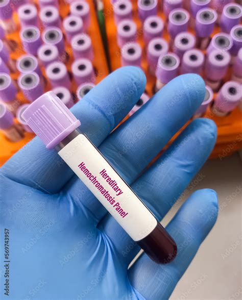 Blood Sample For Hereditary Hemochromatosis Panel Test A Disorder Of