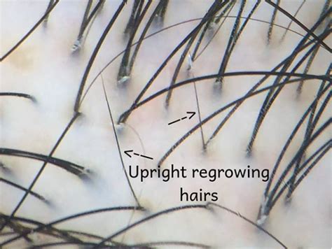 Telogen Effluvium Upright Regrowing Hairs — Donovan Hair Clinic