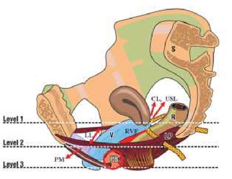 Fig 31 Three Level Repair Level 1 Cardinal Ligament Cl And