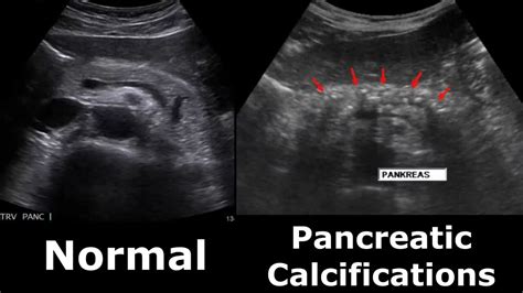 Pancreas Ultrasound Normal Vs Abnormal Appearances Comparison Pancreas