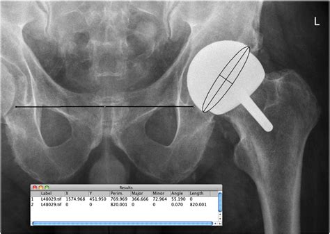 Birmingham Hip Resurfacing A Single Surgeon Series Reported At A