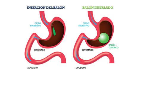 Como Funciona El Balon Gastrico Como Funciona Todo