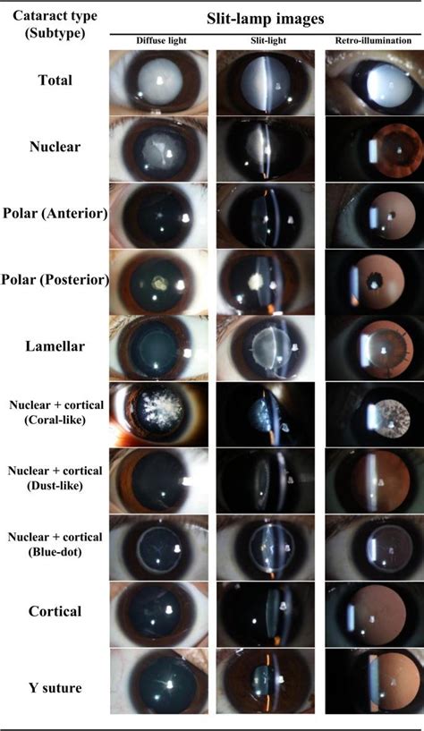 Aetiology Of Visually Significant Congenital And Developmental Cataract