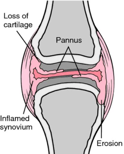 Rheumatoid Arthritis Flashcards Quizlet