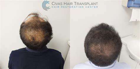 Civas Hair Transplant Fue Hair Transplant Before And After Pictures