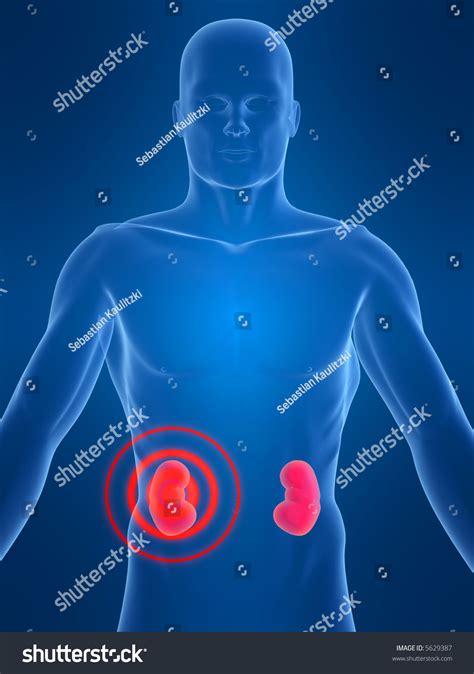 Kidney Inflammation Stock Photo 5629387 : Shutterstock