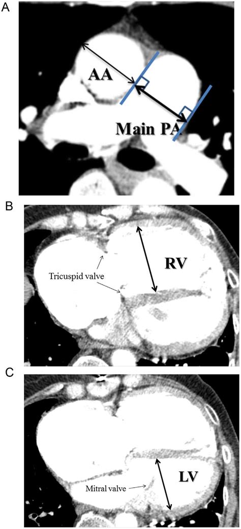 The Definition Of Main Paaa Ratio And Rvlv Ratio A In The Axial Download Scientific