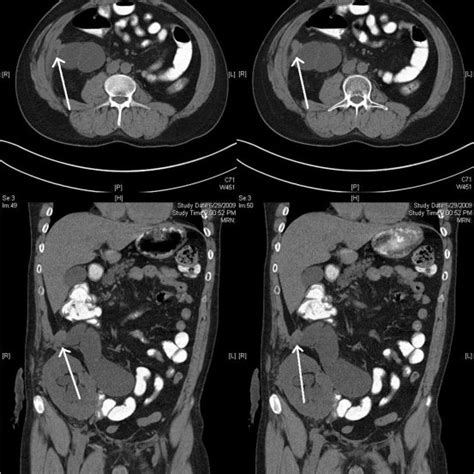 Pdf Renal Transplantation In The Setting Of Prior Urinary Diversion A Case Of Poorly