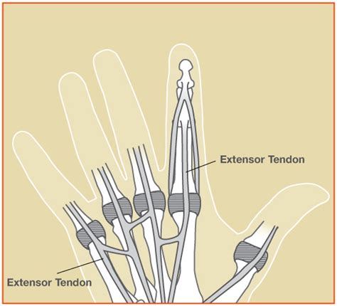 Extensor Tendon Injury Treatment - John Erickson, MD