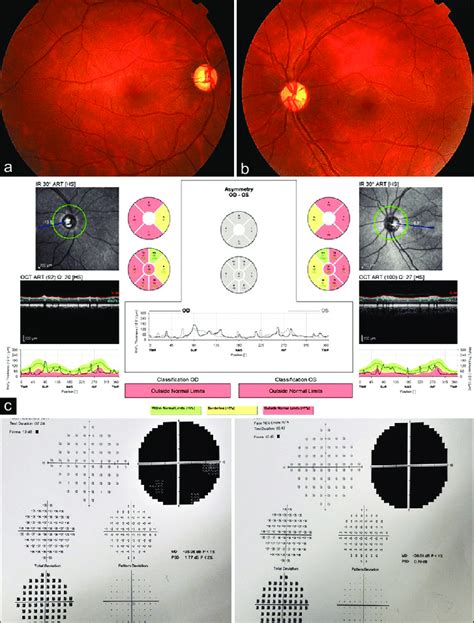 The Color Fundus Photographs Of The Right A And Left B Eyes Of The