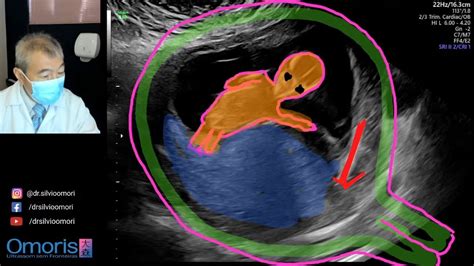 Ultrassonografia Gesta O De Semanas Diu Youtube