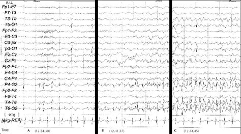 JLE Epileptic Disorders Panayiotopoulos Syndrome VideoEEG