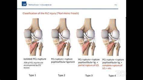 Posterolateral Corner Injuries Of Knee Youtube