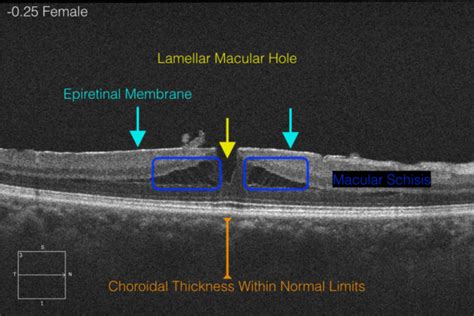 Lamellar Macular Hole - Labelled OCT - EyeCarePD