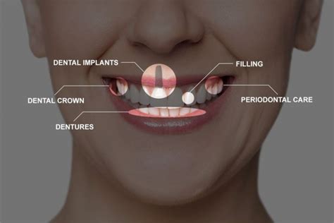 Implant, Alveolar Ridge Expansion – Dinh X. Bui, D.D.S., M.S.