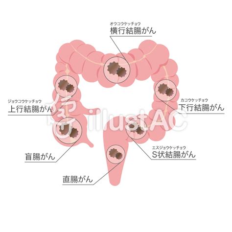 【トップコレクション】 がん イラスト Kawenyajoss