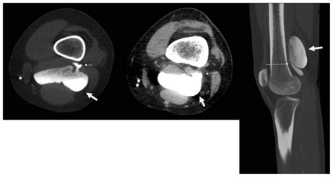 Popliteal Vein Aneurysm Presenting As Recurrent Pulmonary Embolism