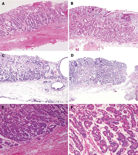 Histological Findings Hematoxylin And Eosin Staining Case 1 A E