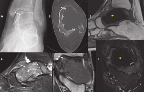 Giant Cell Tumor Frontal Radiograph Of The Left Ankle A Demonstrates Download Scientific