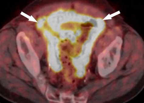 Peritoneal Metastatic Disease In A Hereditary Paraganglioma Syndrome 4