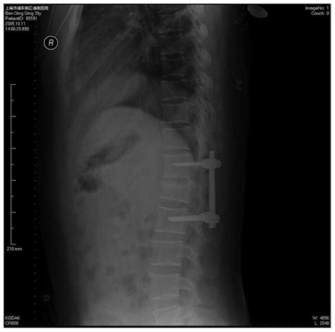 Pedicle Fracture